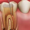 ENDODONTICS (ROOT CANAL TREATMENT)