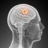 Brain Cancer Surgery