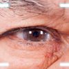 Cataract Surgery