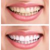 Dental Cosmetics – Whitening