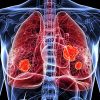 Lung Cancer
