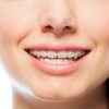 Orthodontics (Tooth and Jaw Disorder Treatments)