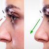 Rhinoplasty