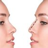 Rhinoplasty