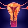 Uterus Cancer Surgery