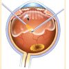 Vitrectomy