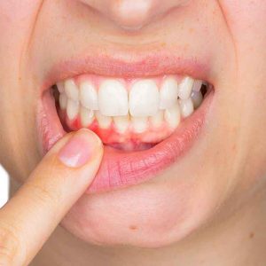 Periodontology( Gum Disease)