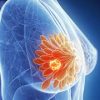 Breast Cancer Surgery