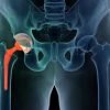 Hip Replacement
