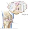 Meniscal Tears