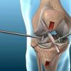 Knee Ligament Surgery - ACL Reconstruction