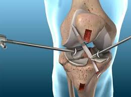 Knee Ligament Surgery - ACL Reconstruction