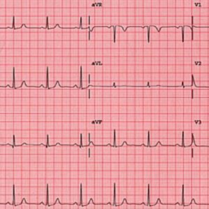 ECG (electrocardiography)