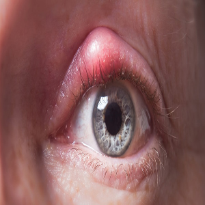 Eye tumor