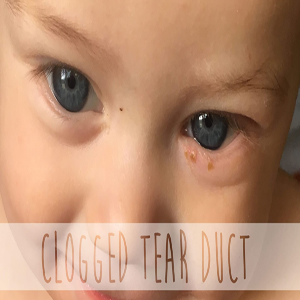 Tear duct obstruction in babies